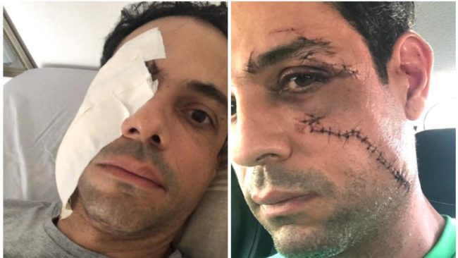 Acusado de ferir empresário com copo é denunciado por lesão gravíssima em Fortaleza