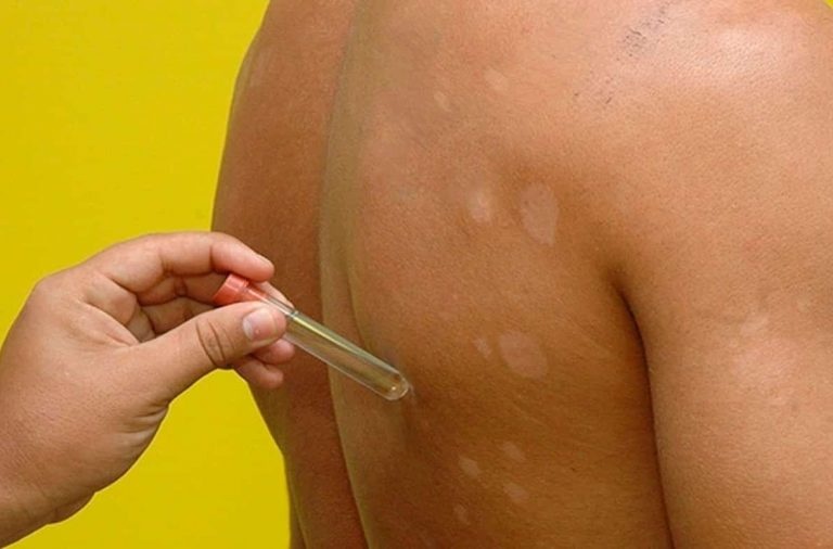 Fortaleza registra queda de 28% nos casos de hanseníase