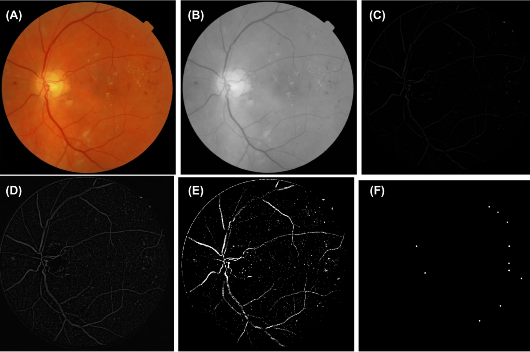 Pesquisa da UFC usa matemática e IA para detectar retinopatia diabética