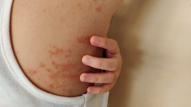 Janeiro Roxo: Brasil registra 22 mil casos de hanseníase em 2024