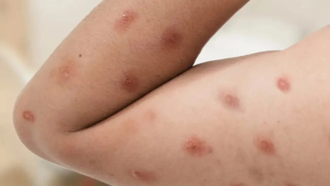 Porto Alegre confirma primeiro caso de Mpox em 2026