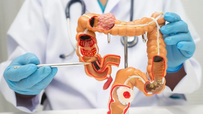 Câncer colorretal: sintomas, fatores de risco e quando fazer colonoscopia