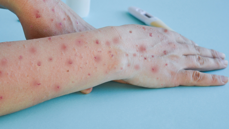 Ceará descarta oito notificações de Mpox e monitora quatro casos em análise