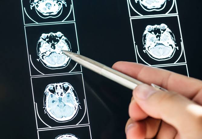 Anvisa amplia uso de medicamentos para tratamento de lúpus e esclerose múltipla