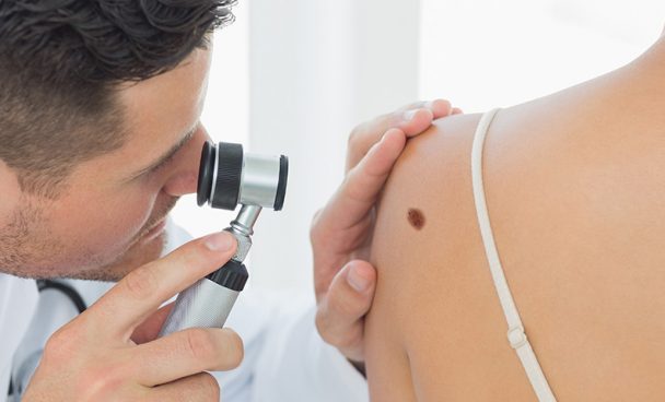 Estudo alerta para casos de melanoma que surgem fora da pele
